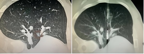 大通速配 体检发现肺磨玻璃结节，只能随访手术二选一？“超微创”的微波消融，了解一下